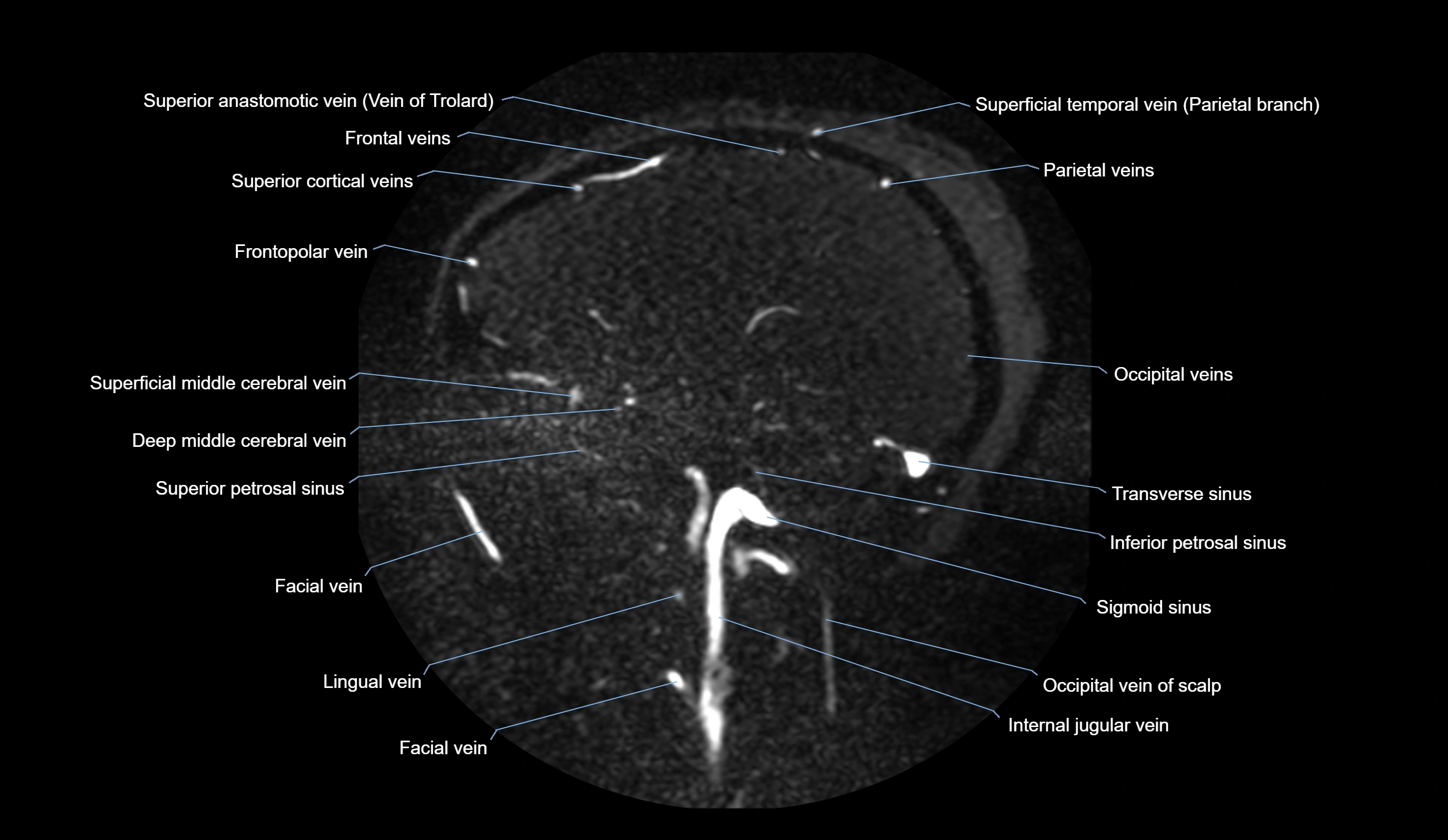 MRV brain sagittal anatomy 3T MRI images -img-01015-00028.webp